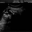 Brandy's ultrasound