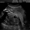 Brandy's ultrasound #3
